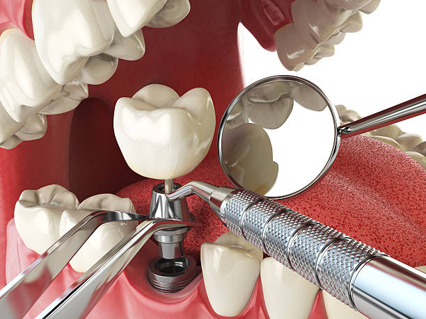 Best Emergency Wisdom Teeth Removal in Fennville, MI